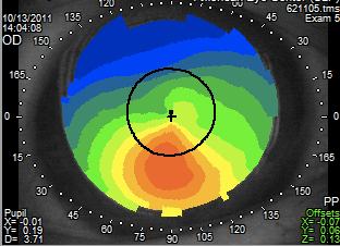 Corneal topography shows steepening of the lower segment of the cornea