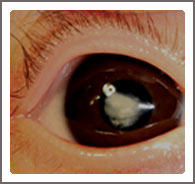 Congenital Cataract