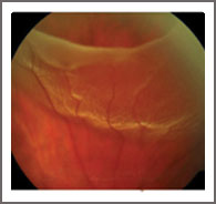 Retinal Detachment