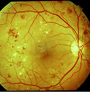 What is the Retina