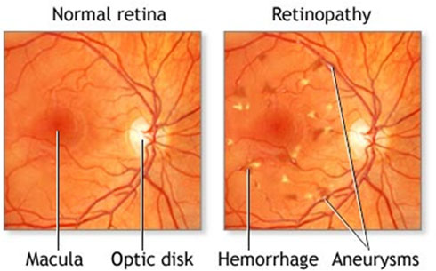 What is the Retina